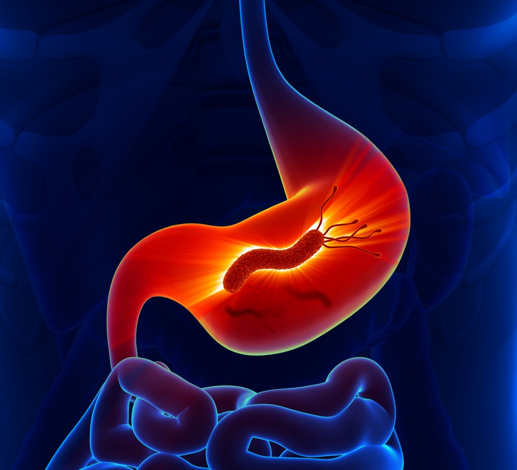 Антитела класса IgG к Helicobacter pylori (Anti H. pylori IgG)